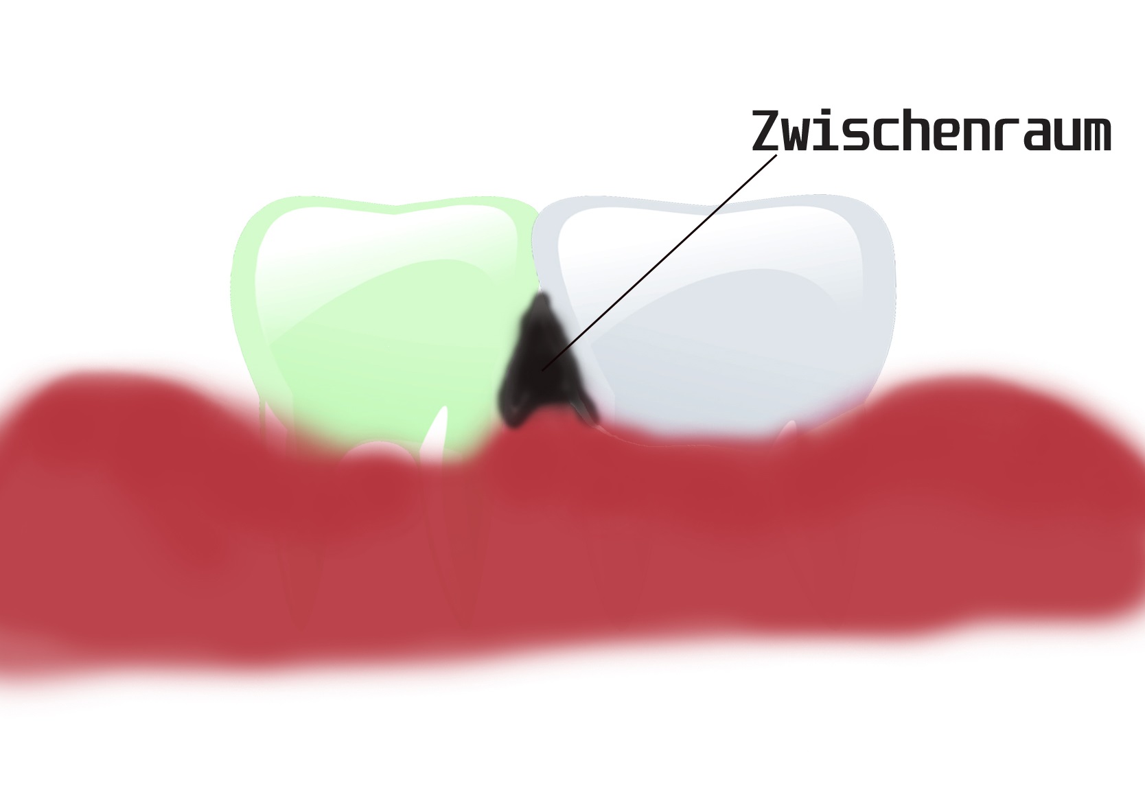 Zahnzwischenraum
